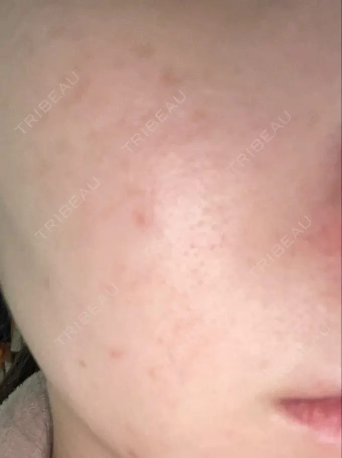 光治療（フォトフェイシャルなど） 新宿美容外科クリニック 新宿院 AFTER メイン用