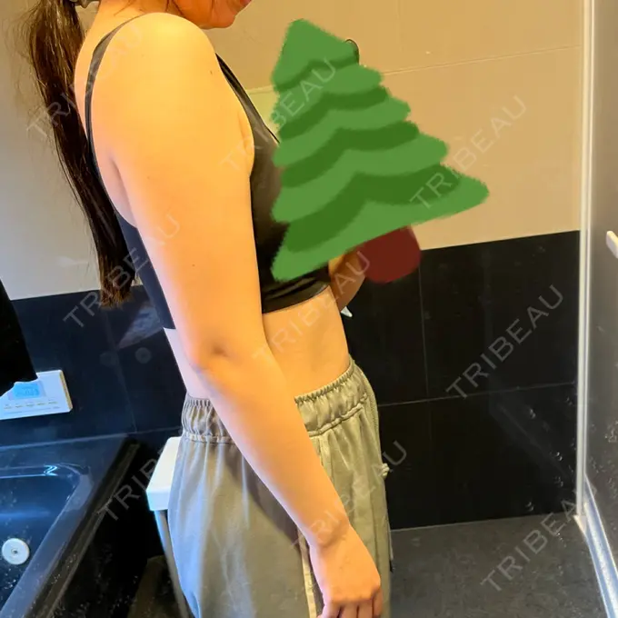 脂肪冷却（二の腕） 湘南美容クリニック 大阪梅田本院 AFTER メイン用