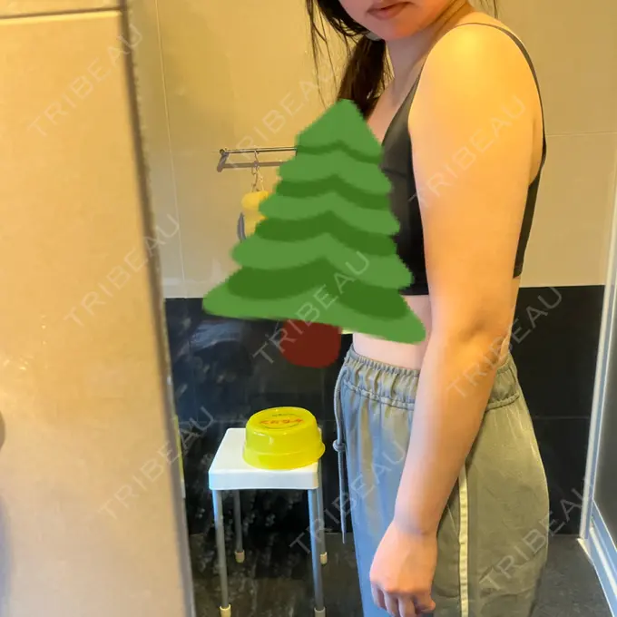 脂肪冷却（二の腕） 湘南美容クリニック 大阪梅田本院 DAY 155 メイン用