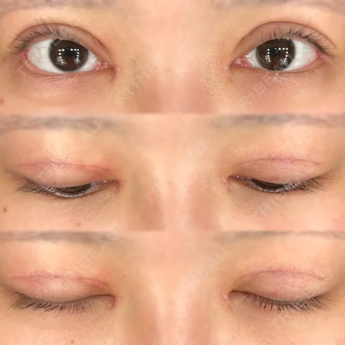 二重切開 / 目頭切開 / クマ治療 / 目尻切開 / 上まぶたたるみ取り / 下まぶたの脂肪取り / 脂肪注入（目の下） 湘南美容クリニック 大阪堺東院 DAY 31 メイン用