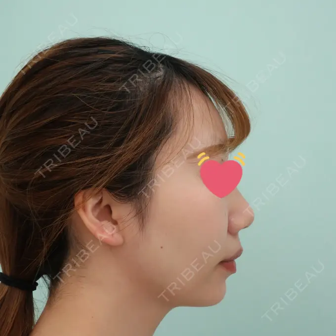 あごプロテーゼ / 脂肪吸引（顔） / ボトックス（あご） / ボトックス（エラ・小顔） WOM CLINIC GINZA （ワム クリニック ギンザ） AFTER メイン用