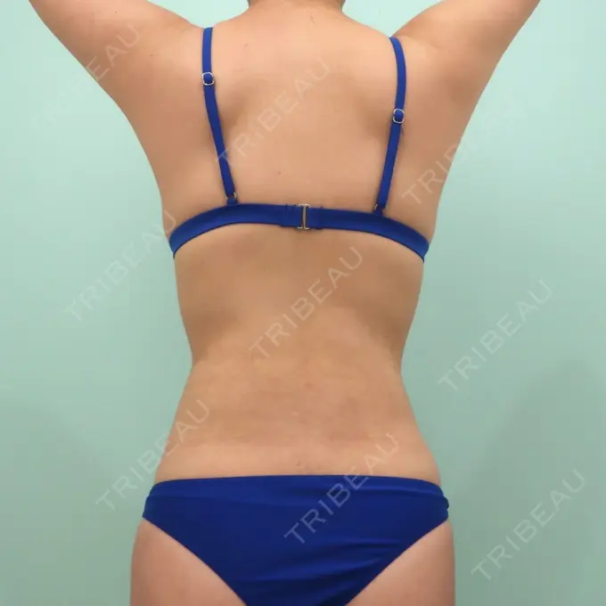 脂肪吸引（お腹） / 脂肪吸引（背中） WOM CLINIC GINZA （ワム クリニック ギンザ） DAY 40 メイン用