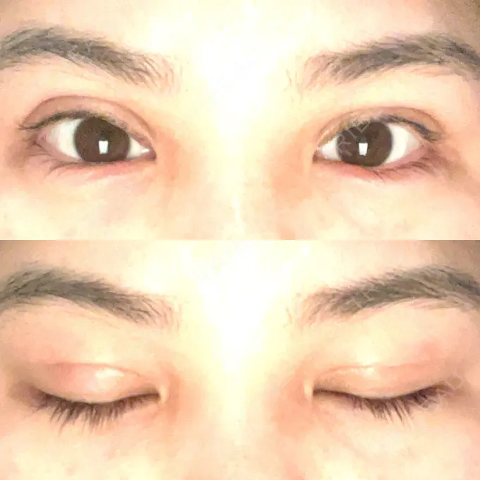 二重埋没 / 糸リフト / 脂肪吸引（顔） / ヒアルロン酸注入（涙袋） / ピアス穴あけ ルラ美容クリニック 大阪本院 DAY 15 メイン用