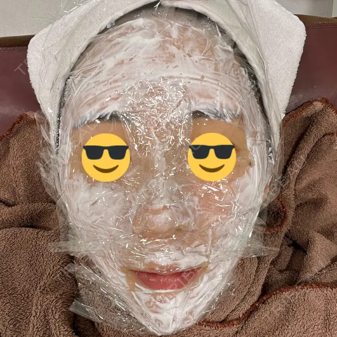 ニードルRF（ポテンツァなど） オラクル美容皮膚科 東京新宿院 DAY 0 メイン用