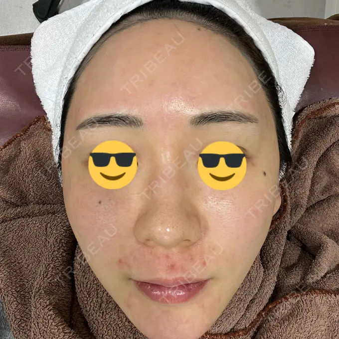 ニードルRF（ポテンツァなど） オラクル美容皮膚科 東京新宿院 DAY 0 メイン用