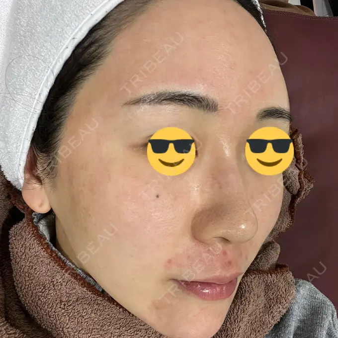 ニードルRF（ポテンツァなど） オラクル美容皮膚科 東京新宿院 DAY 0 メイン用