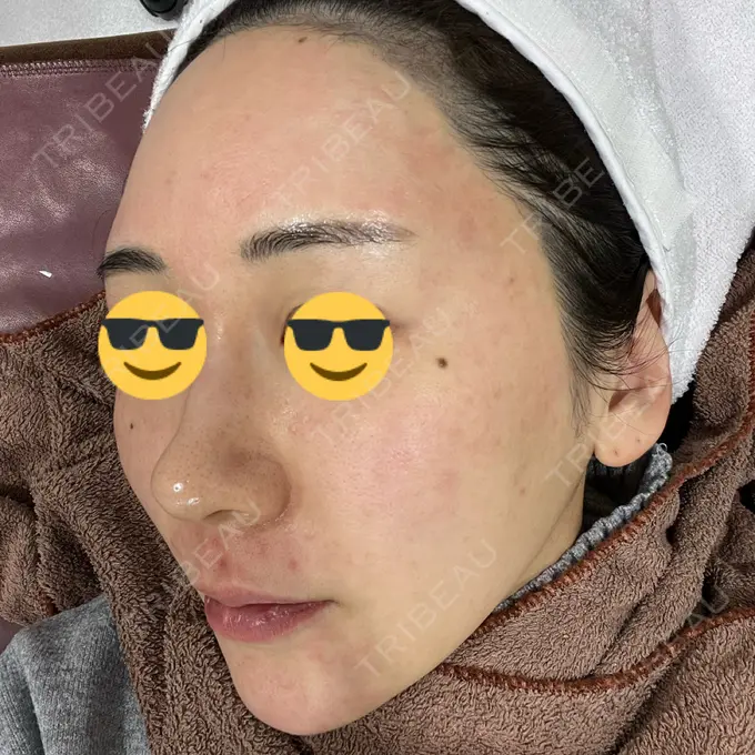 ニードルRF（ポテンツァなど） オラクル美容皮膚科 東京新宿院 DAY 0 メイン用