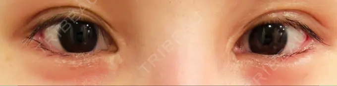 目尻切開 / タレ目形成・グラマラスライン（埋没） LOUIS CLINIC 二子玉川院【ルイクリニック】 DAY 2 メイン用