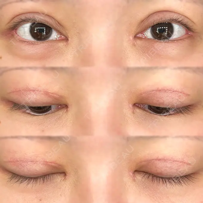 二重切開 / 目頭切開 / クマ治療 / 目尻切開 / 上まぶたたるみ取り / 下まぶたの脂肪取り / 脂肪注入（目の下） 湘南美容クリニック 大阪堺東院 DAY 32 メイン用