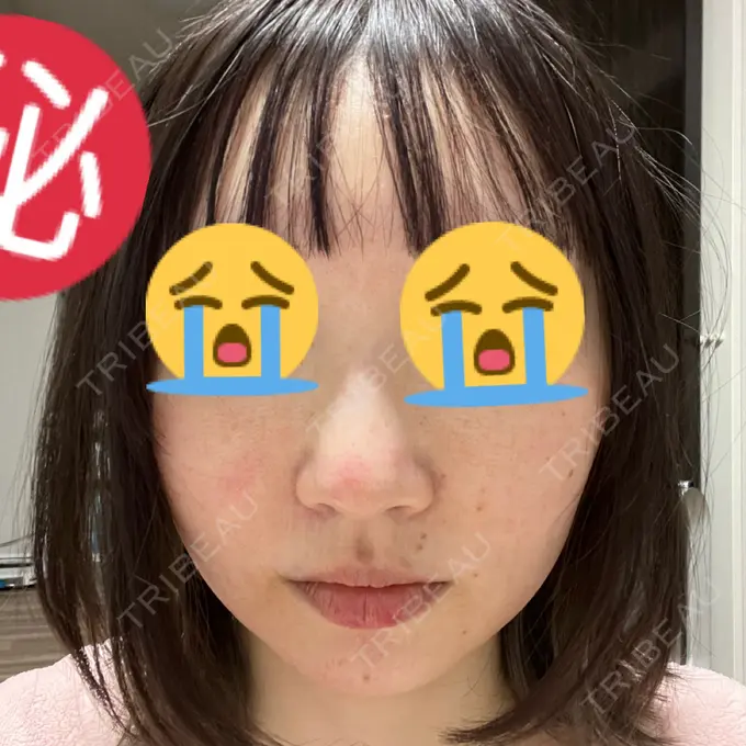 ニードルRF（ポテンツァなど） 東京美容外科 池袋院 DAY 1 メイン用