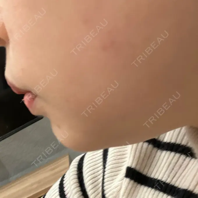 ハイフ（顔） A CLINIC（エークリニック） 仙台院 AFTER メイン用