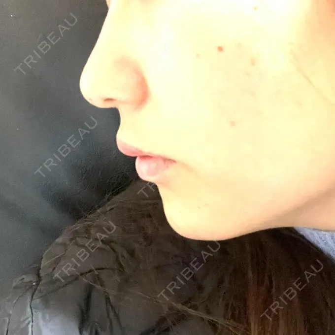 ボトックス（あご） / ヒアルロン酸注入（あご） / ヒアルロン酸注入（唇） 石倉クリニック 水戸院 DAY 1 メイン用