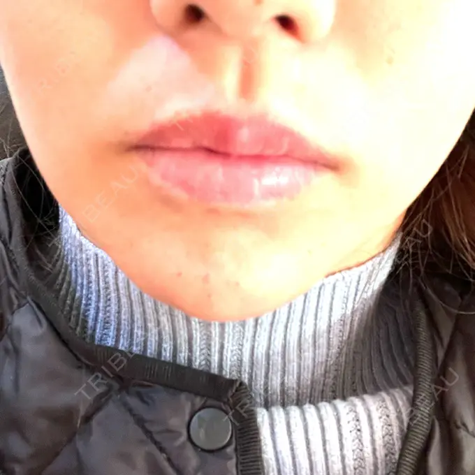 ボトックス（あご） / ヒアルロン酸注入（あご） / ヒアルロン酸注入（唇） 石倉クリニック 水戸院 DAY 1 メイン用