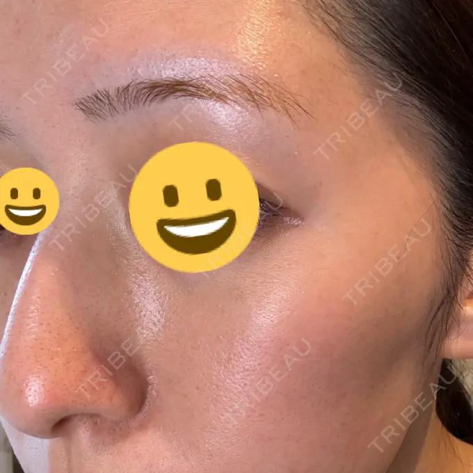 シミ取りレーザー Mavie Beauty Clinic （マヴィービューティークリニック） DAY 8 メイン用