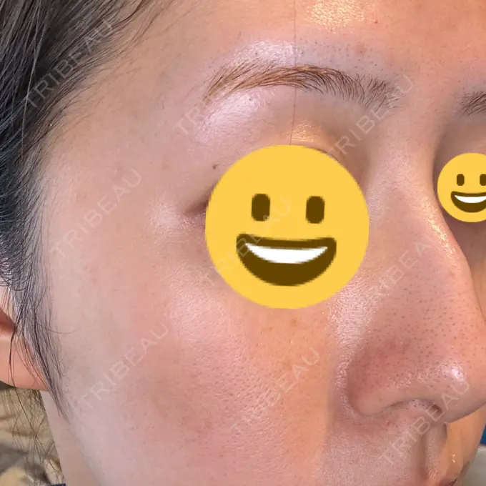 シミ取りレーザー Mavie Beauty Clinic （マヴィービューティークリニック） DAY 8 メイン用