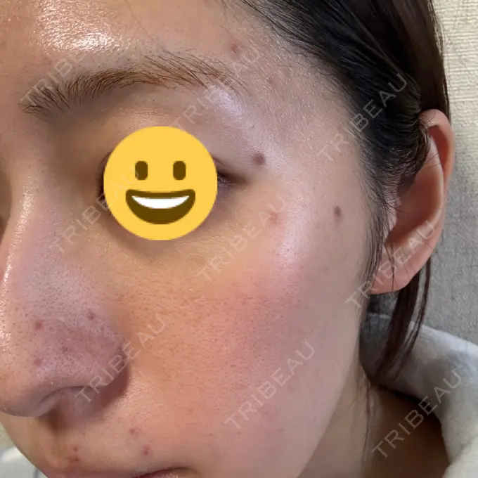 シミ取りレーザー Mavie Beauty Clinic （マヴィービューティークリニック） DAY 1 メイン用