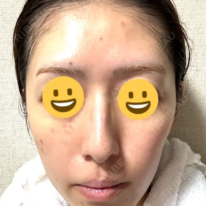 シミ取りレーザー Mavie Beauty Clinic （マヴィービューティークリニック） DAY 1 メイン用