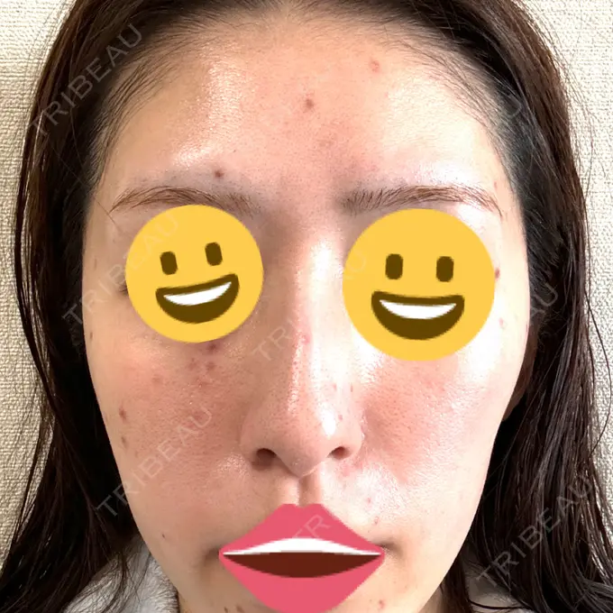 シミ取りレーザー Mavie Beauty Clinic （マヴィービューティークリニック） DAY 3 メイン用