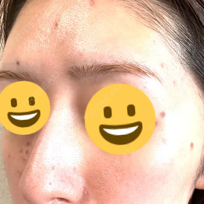 シミ取りレーザー Mavie Beauty Clinic （マヴィービューティークリニック） DAY 3 メイン用