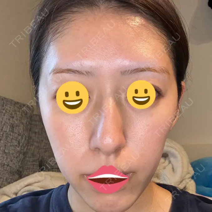 シミ取りレーザー Mavie Beauty Clinic （マヴィービューティークリニック） AFTER メイン用