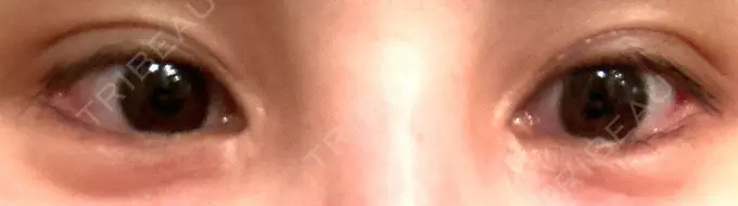 目尻切開 / タレ目形成・グラマラスライン（埋没） LOUIS CLINIC 二子玉川院【ルイクリニック】 DAY 3 メイン用