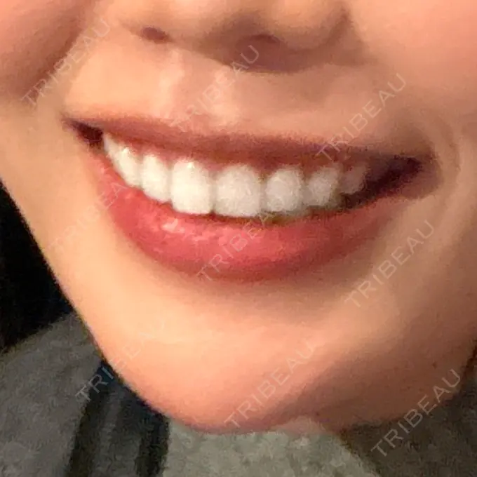 アートメイク（唇） にしまき美容スキンクリニック AFTER メイン用