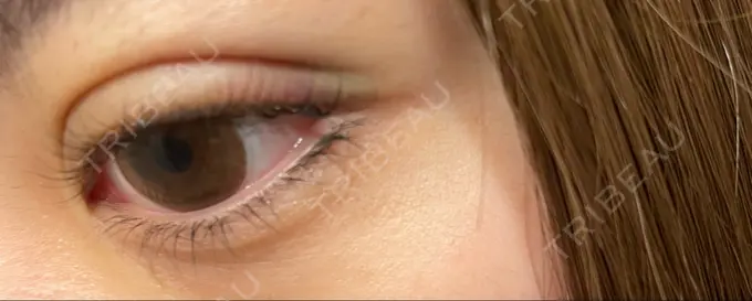 二重埋没 仙台TAクリニック DAY 2 メイン用