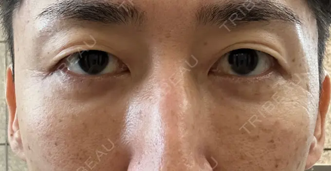 下まぶたたるみ取り / 脂肪注入（目の下） 湘南美容クリニック 池袋東口院 AFTER メイン用