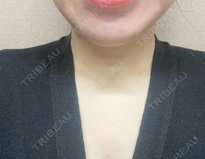 ボトックス（眉間） 湘南美容クリニック 京都院 AFTER メイン用