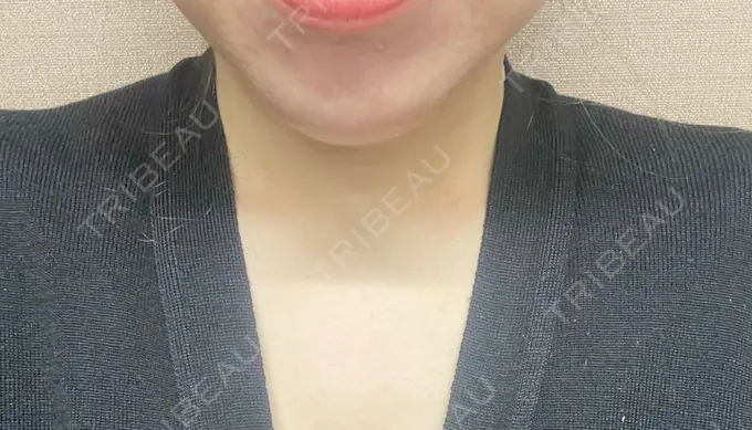 ボトックス（眉間） 湘南美容クリニック 京都院 DAY 11 メイン用