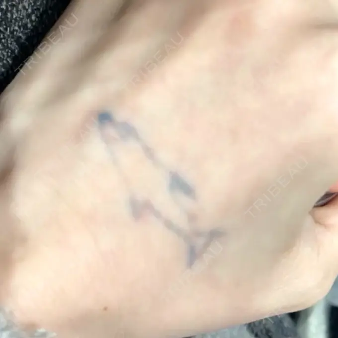 タトゥー除去 ziz CLINIC DAY 81 メイン用