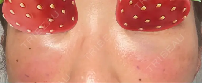 クマ治療 湘南美容クリニック 藤沢院 DAY 0 メイン用