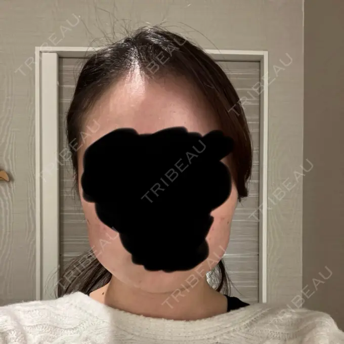 脂肪溶解注射（顔） 表参道ウィズ・クリニック AFTER メイン用