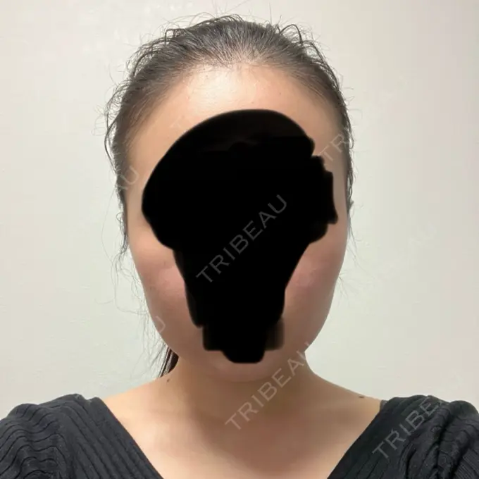 脂肪溶解注射（顔） 表参道ウィズ・クリニック DAY 8 メイン用