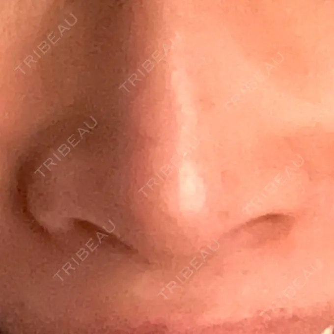 小鼻縮小（非切開） TCB東京中央美容外科 世田谷院 AFTER メイン用