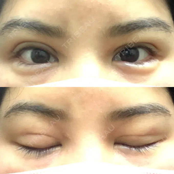 二重埋没 / 糸リフト / 脂肪吸引（顔） / ヒアルロン酸注入（涙袋） / ピアス穴あけ ルラ美容クリニック 大阪本院 DAY 19 メイン用