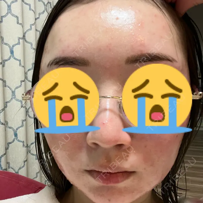 ニードルRF（ポテンツァなど） 東京美容外科 池袋院 DAY 3 メイン用