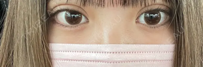 二重埋没 仙台TAクリニック DAY 3 メイン用