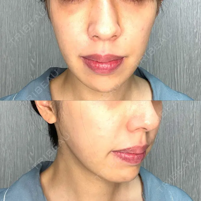 糸リフト / 脂肪吸引（顔） / ジョールファット除去 / ボトックス（あご） / ヒアルロン酸注入（あご） / ボトックス（エラ・小顔） RIVER CLINIC（リバークリニック） DAY 18 メイン用