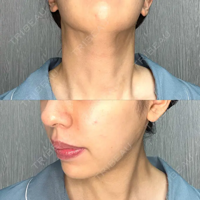 糸リフト / 脂肪吸引（顔） / ジョールファット除去 / ボトックス（あご） / ヒアルロン酸注入（あご） / ボトックス（エラ・小顔） RIVER CLINIC（リバークリニック） DAY 18 メイン用