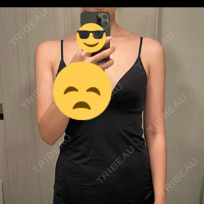 脂肪吸引（二の腕） Mods Clinic（モッズクリニック） 名古屋院 DAY 62 メイン用