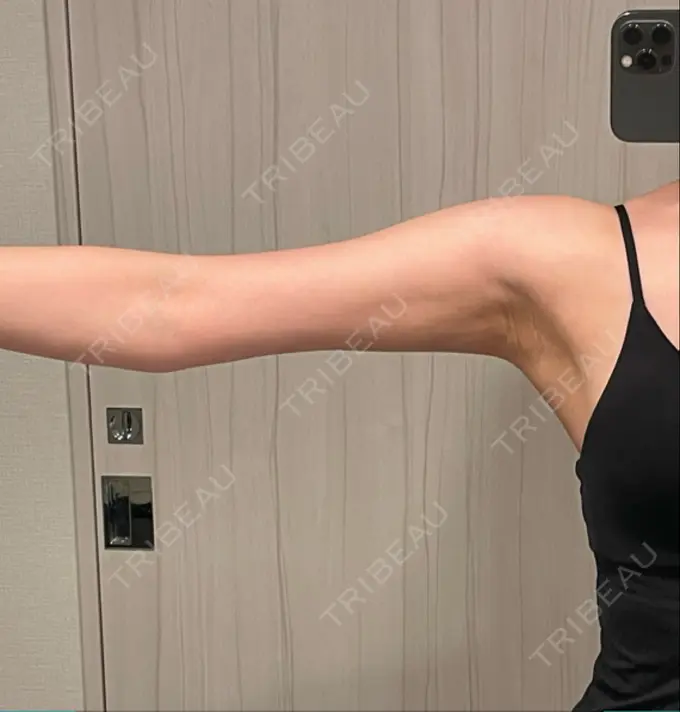 脂肪吸引（二の腕） Mods Clinic（モッズクリニック） 名古屋院 DAY 62 メイン用