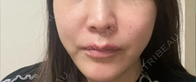 脂肪溶解注射（顔） 東京たかはしクリニック 練馬院 DAY 2 メイン用