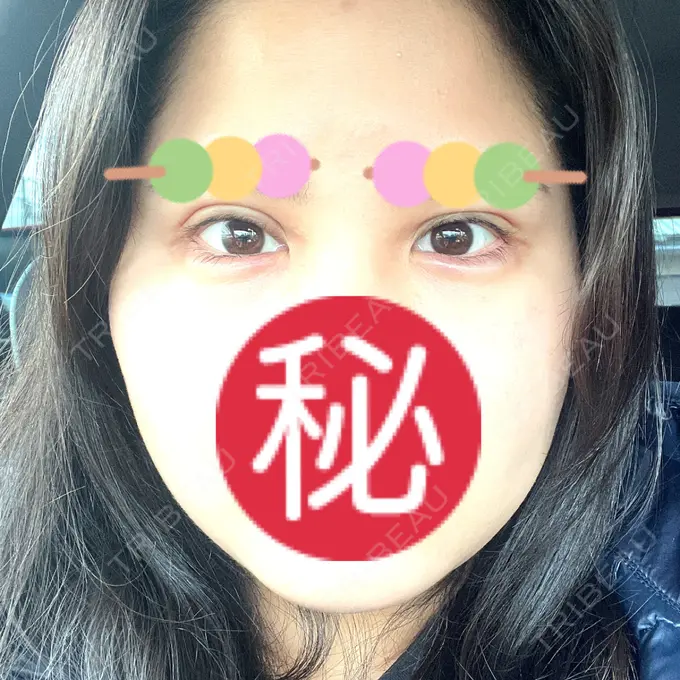 二重埋没 / 糸リフト / 脂肪吸引（顔） / ヒアルロン酸注入（涙袋） / ピアス穴あけ ルラ美容クリニック 大阪本院 AFTER メイン用