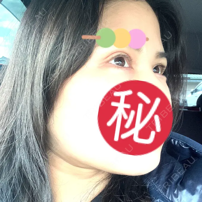 二重埋没 / 糸リフト / 脂肪吸引（顔） / ヒアルロン酸注入（涙袋） / ピアス穴あけ ルラ美容クリニック 大阪本院 DAY 20 メイン用