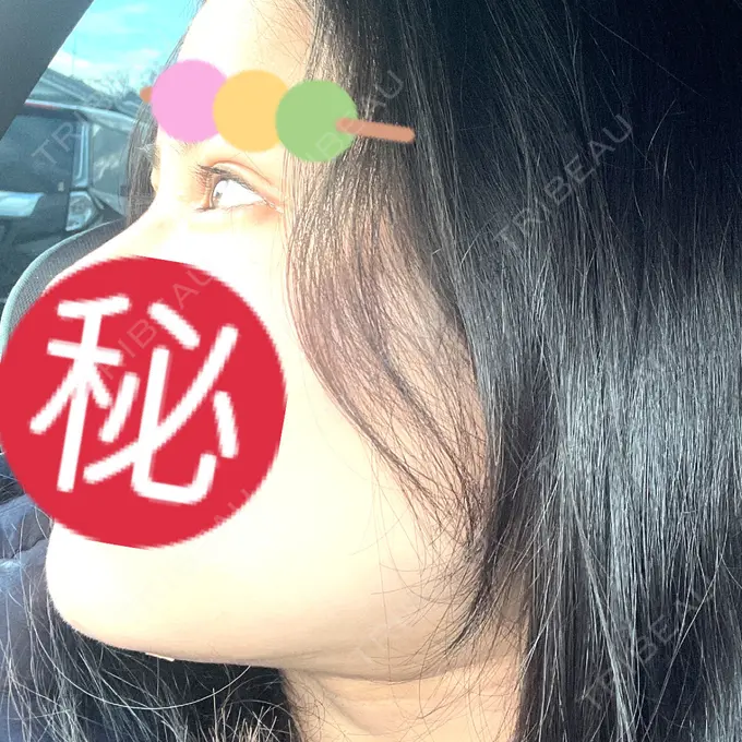 二重埋没 / 糸リフト / 脂肪吸引（顔） / ヒアルロン酸注入（涙袋） / ピアス穴あけ ルラ美容クリニック 大阪本院 DAY 20 メイン用