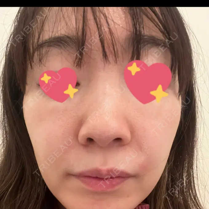 ヒアルロン酸注入（鼻翼基部） 松倉クリニック 表参道 DAY 0 メイン用