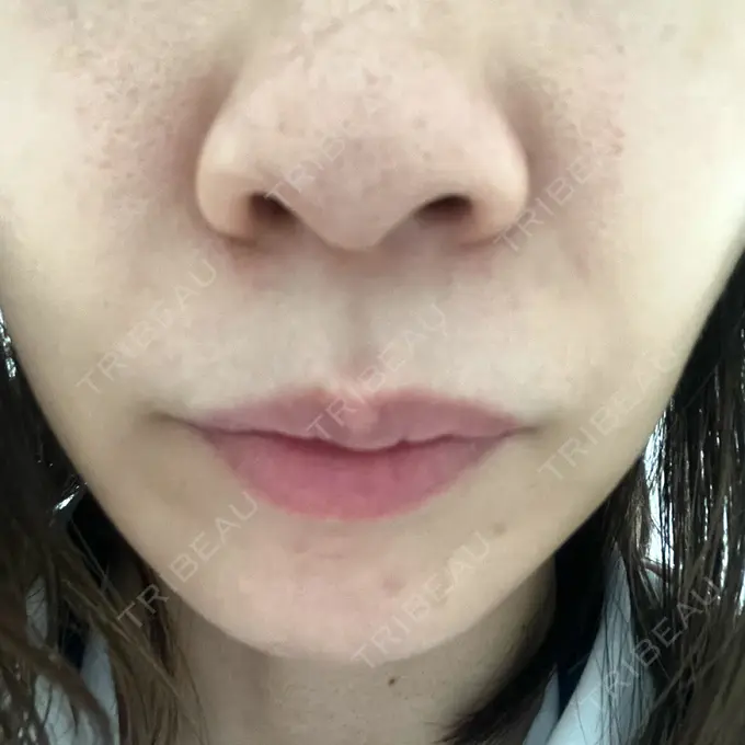 ヒアルロン酸注入（鼻翼基部） 松倉クリニック 表参道 DAY 1 メイン用