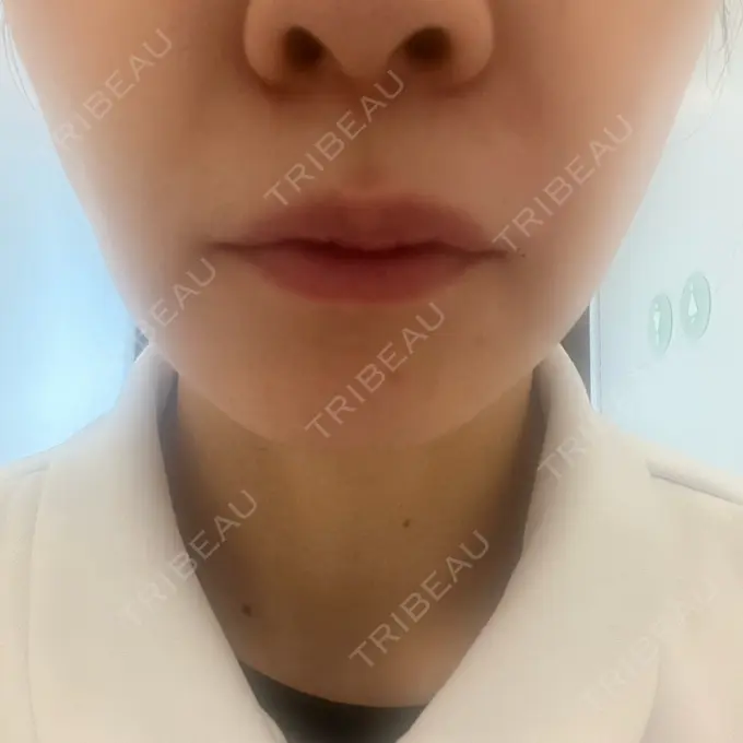 ヒアルロン酸注入（鼻翼基部） 松倉クリニック 表参道 DAY 2 メイン用