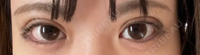 二重埋没 仙台TAクリニック DAY 4 メイン用